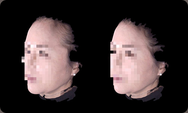 3D 입체 스캐너를 이용한 분석