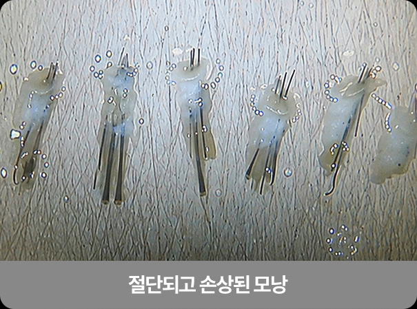 절단되고 손상된 모낭