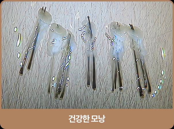 건강한 모낭