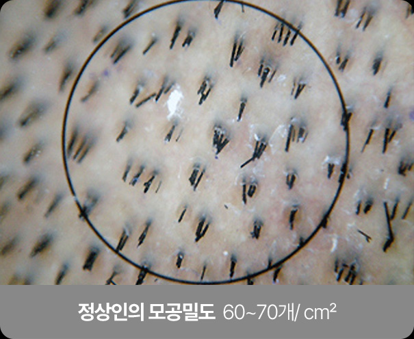정상인의 모공밀도 60~70개/ cm²