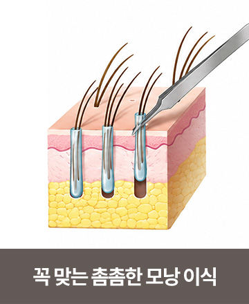 꼭 맞는 촘촘한 모낭 이식
