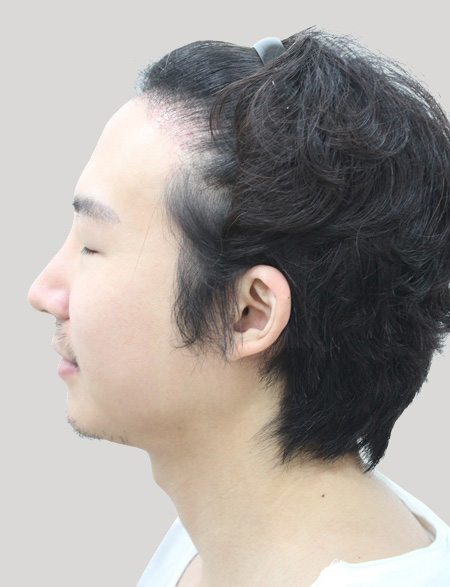 수술 후 3주 상태