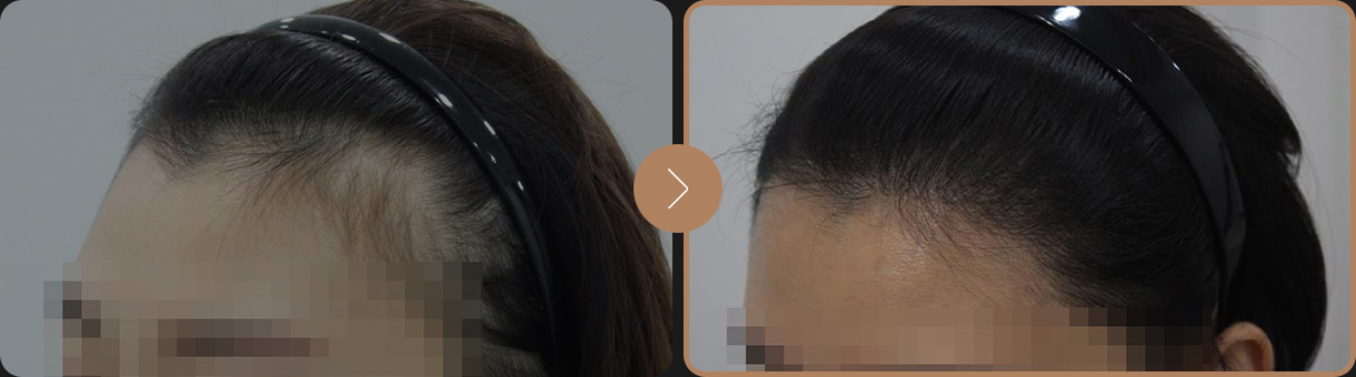 모빈치의원 잔머리 헤어라인 사례 사진 1
