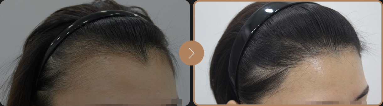 모빈치의원 잔머리 헤어라인 사례 사진 3