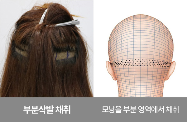 부분삭발 모발이식 채취 방식