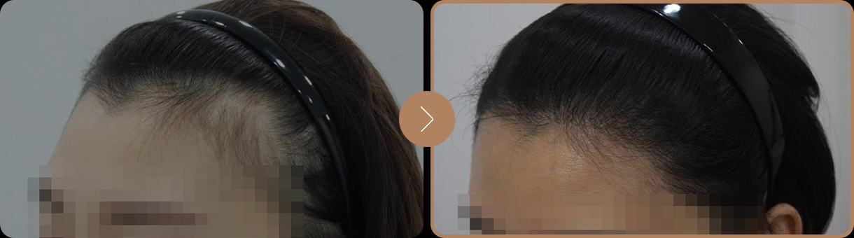 모빈치의원 비절개 무삭발 사례 사진 1
