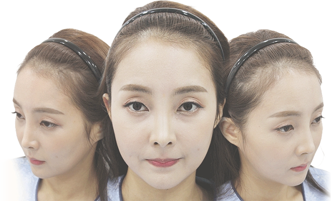 헤어라인 교정 전 이미지