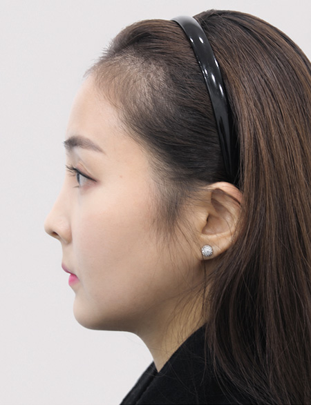 수술 후 4개월 상태