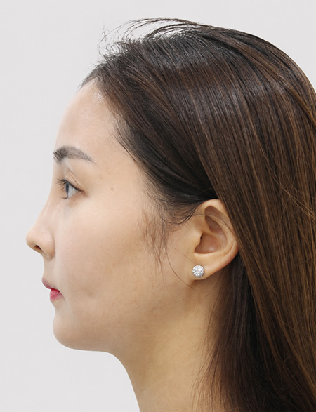 수술 후 1년 상태